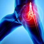 3 Most Common Hip Injuries: Prevention and Remedies